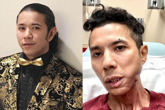 Hình ảnh Kasim Hoàng Vũ trước và trong quá trình chiến đấu với bạo bệnh, thể hiện sự thay đổi về sức khỏe.