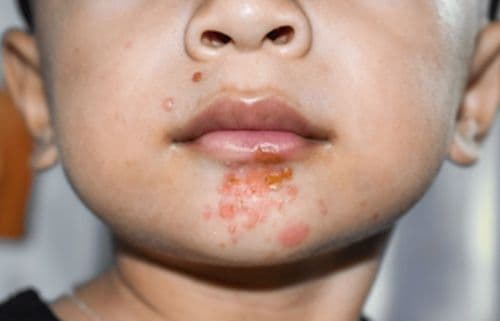 Khuôn mặt một bệnh nhi, gợi nhắc về tầm quan trọng của an toàn người bệnh và hậu quả sai sót y khoa.